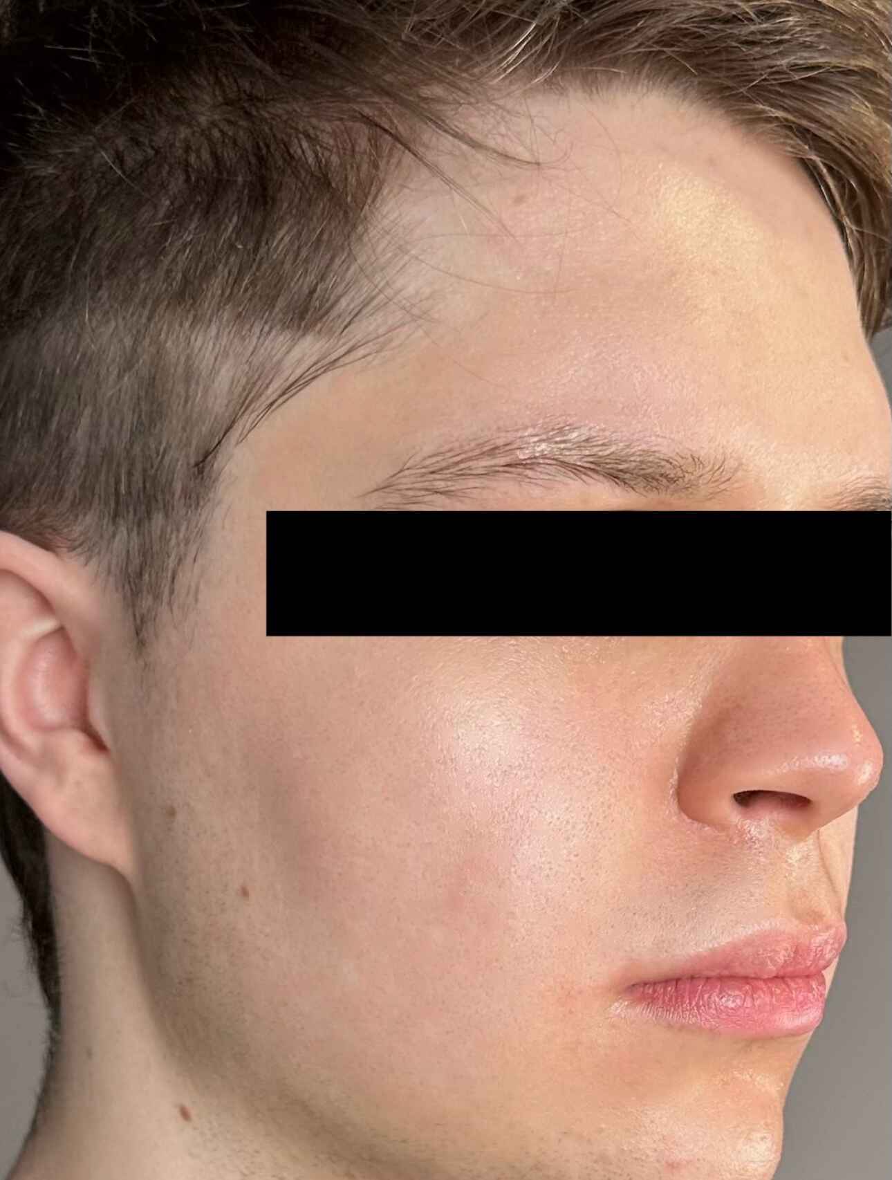 After DermSculpt BioNeedling Treatment in Melbourne clinic – Clearer skin, reduced acne scars, improved skin texture, and minimised pores.