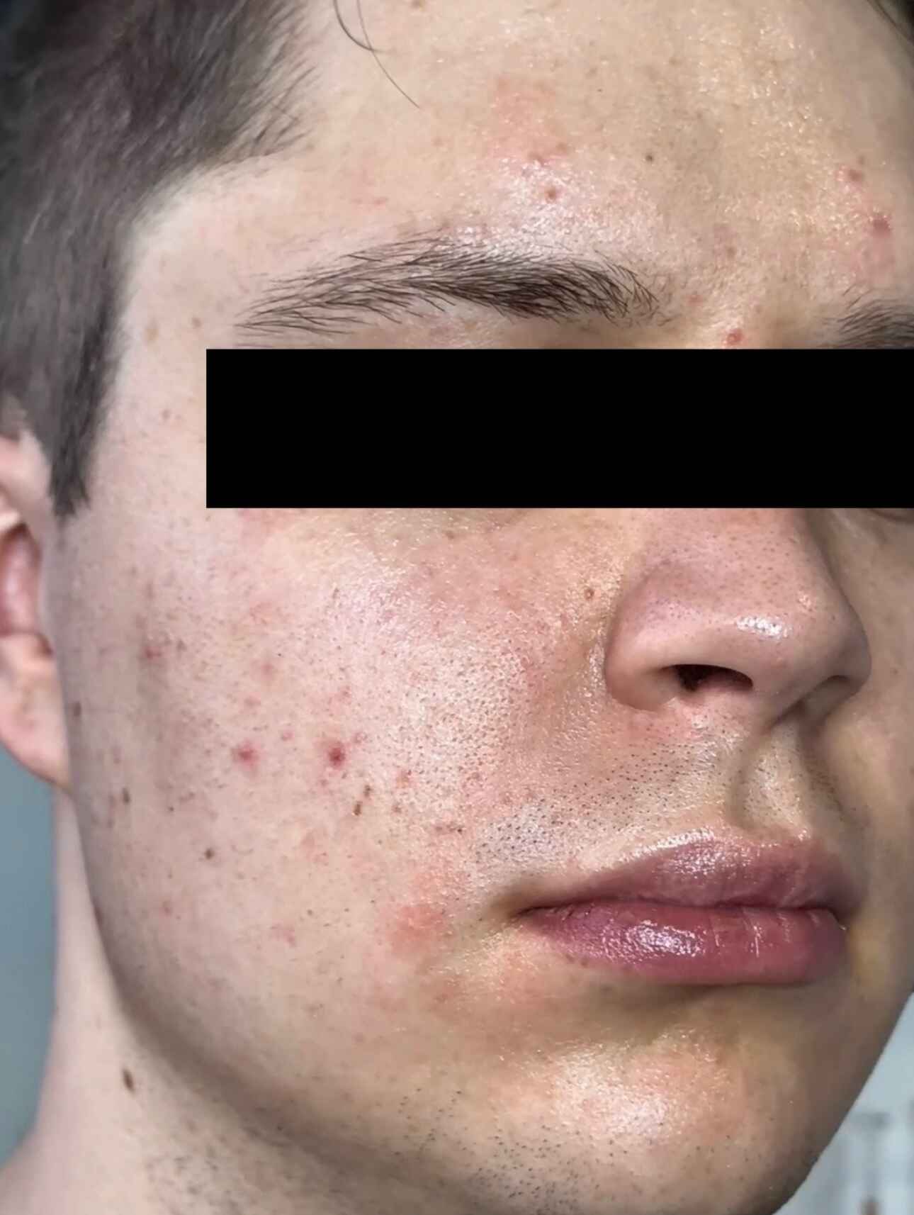 Before DermSculpt BioNeedling Treatment in Melbourne clinic – Visible acne scars, uneven skin texture, and enlarged pores.