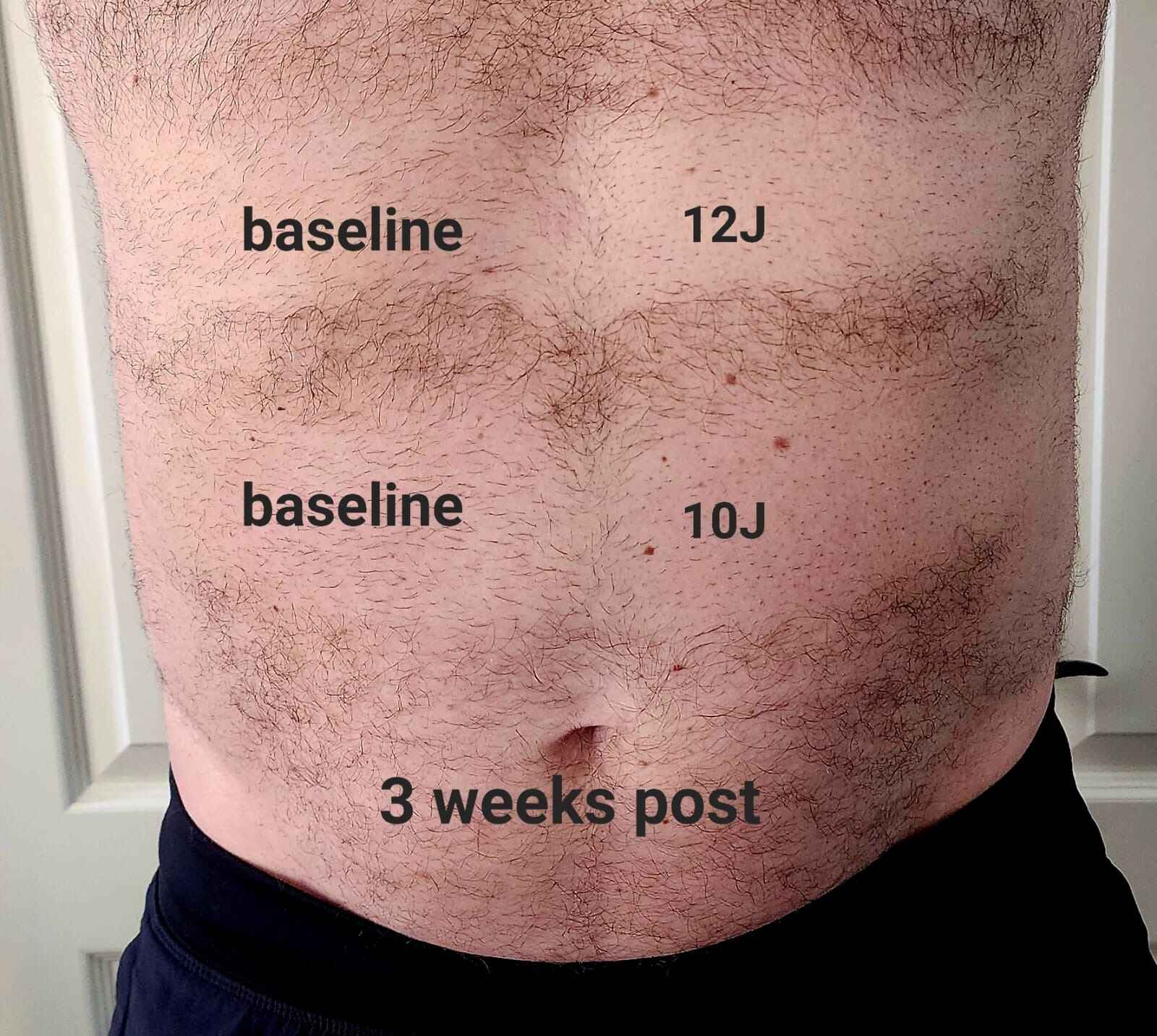 Before and after EPILED LED hair removal treatment on the stomach, showing<br />
energy settings (baseline 12J, baseline 10J) and results 3 weeks after treatment,<br />
using laser-like LED technology.