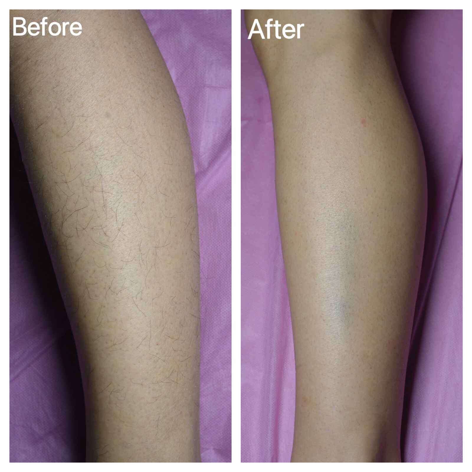 Before and After EPILED LED hair removal treatment on the leg, with smooth, hair-free skin<br />
post-treatment, using laser-like LED technology.