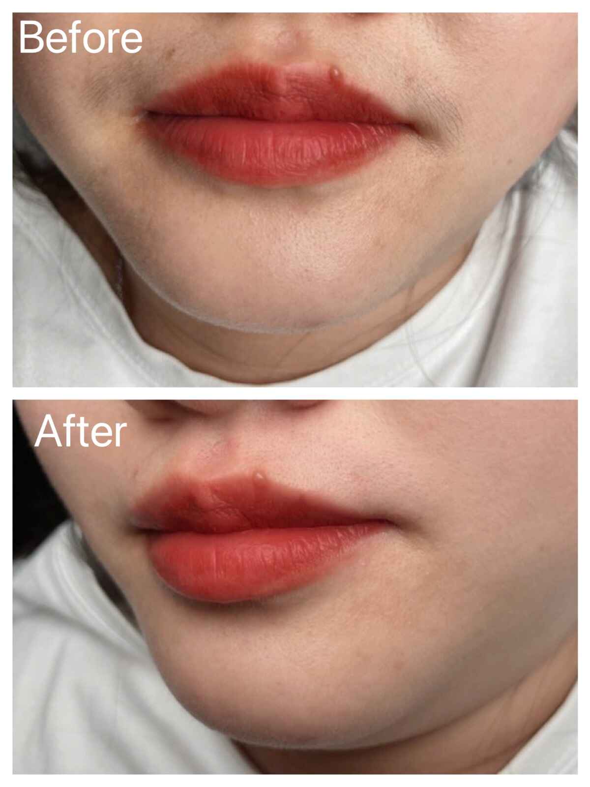 After EPILED LED hair removal treatment on the upper lip, revealing smooth, hair-<br />
free skin with laser-like LED technology.