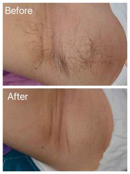 Before and After EPILED LED hair removal treatment on the underarm, showing smooth, hair-<br />
free skin post-treatment with laser-like technology.