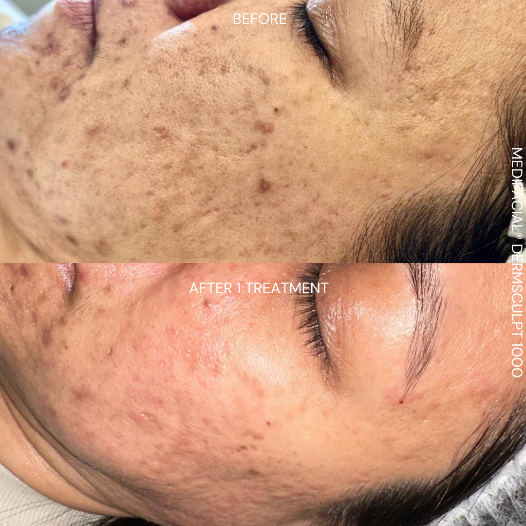 After DermSculpt BioNeedling Treatment in Melbourne clinic – Clearer skin, reduced acne scars, improved skin texture, and minimised pores.