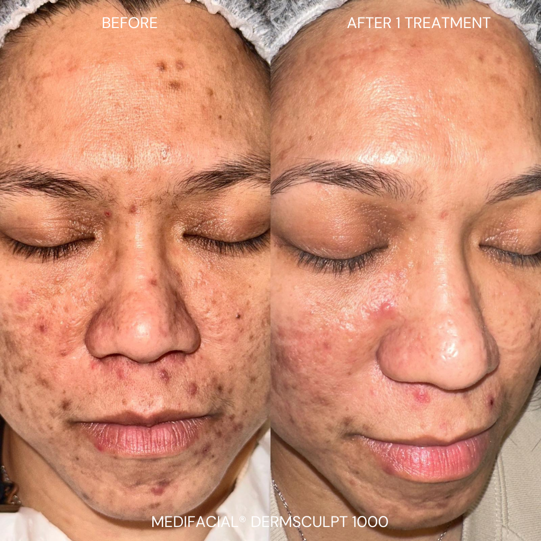 After DermSculpt BioNeedling Treatment in Melbourne clinic – Clearer skin, reduced acne scars, improved skin texture, and minimised pores.