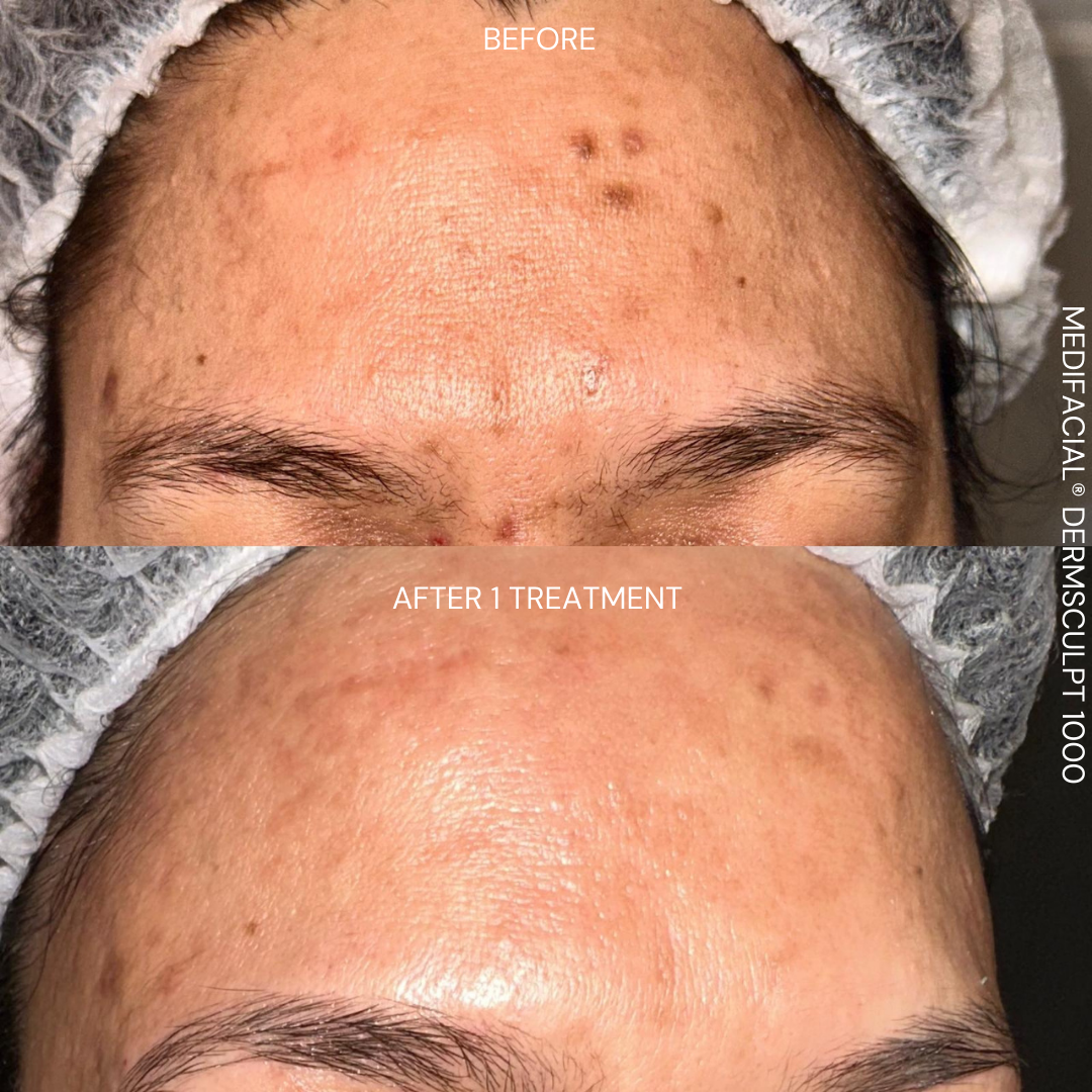 After DermSculpt BioNeedling Treatment in Melbourne clinic – Clearer skin, reduced acne scars, improved skin texture, and minimised pores.