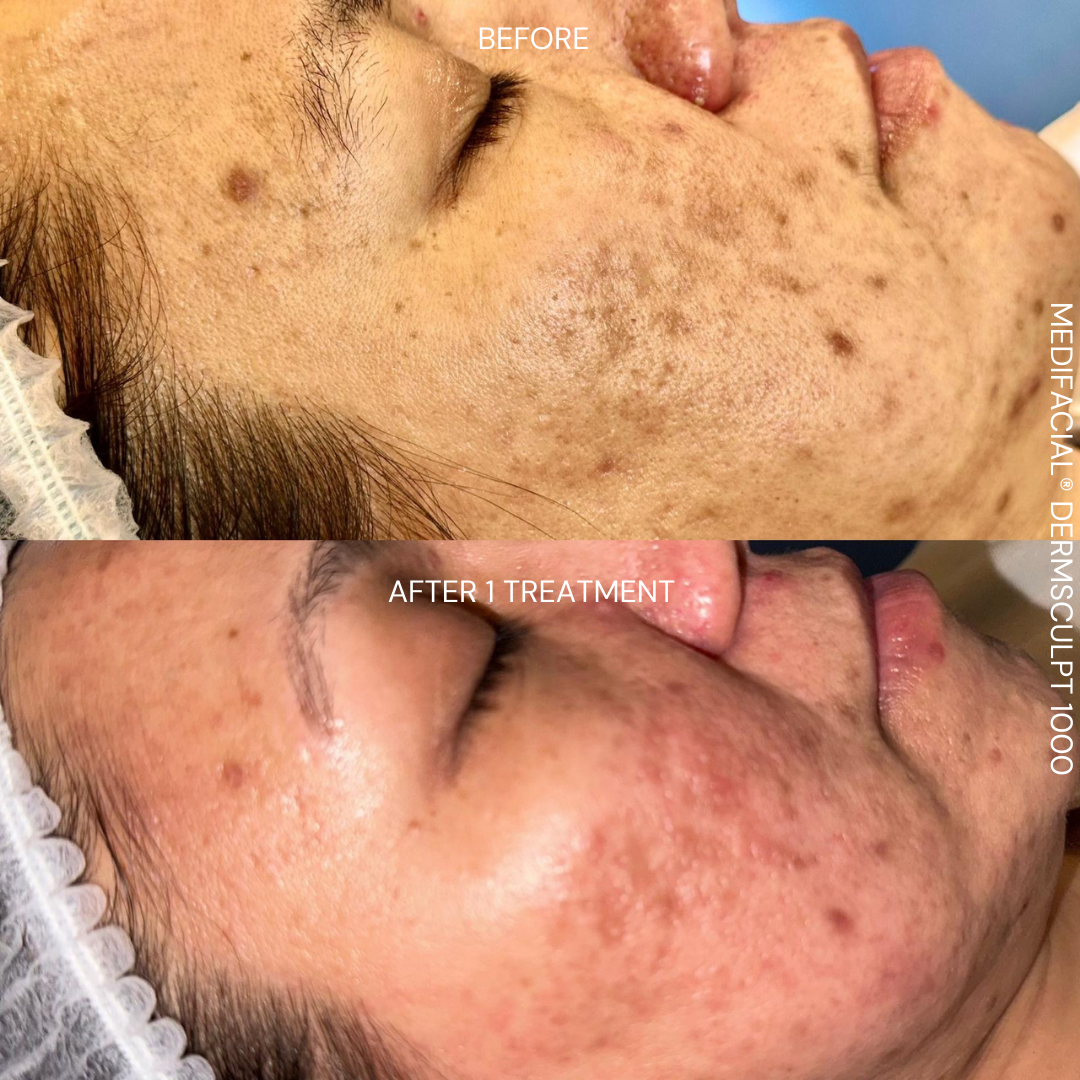 After DermSculpt BioNeedling Treatment in Melbourne clinic – Clearer skin, reduced acne scars, improved skin texture, and minimised pores.