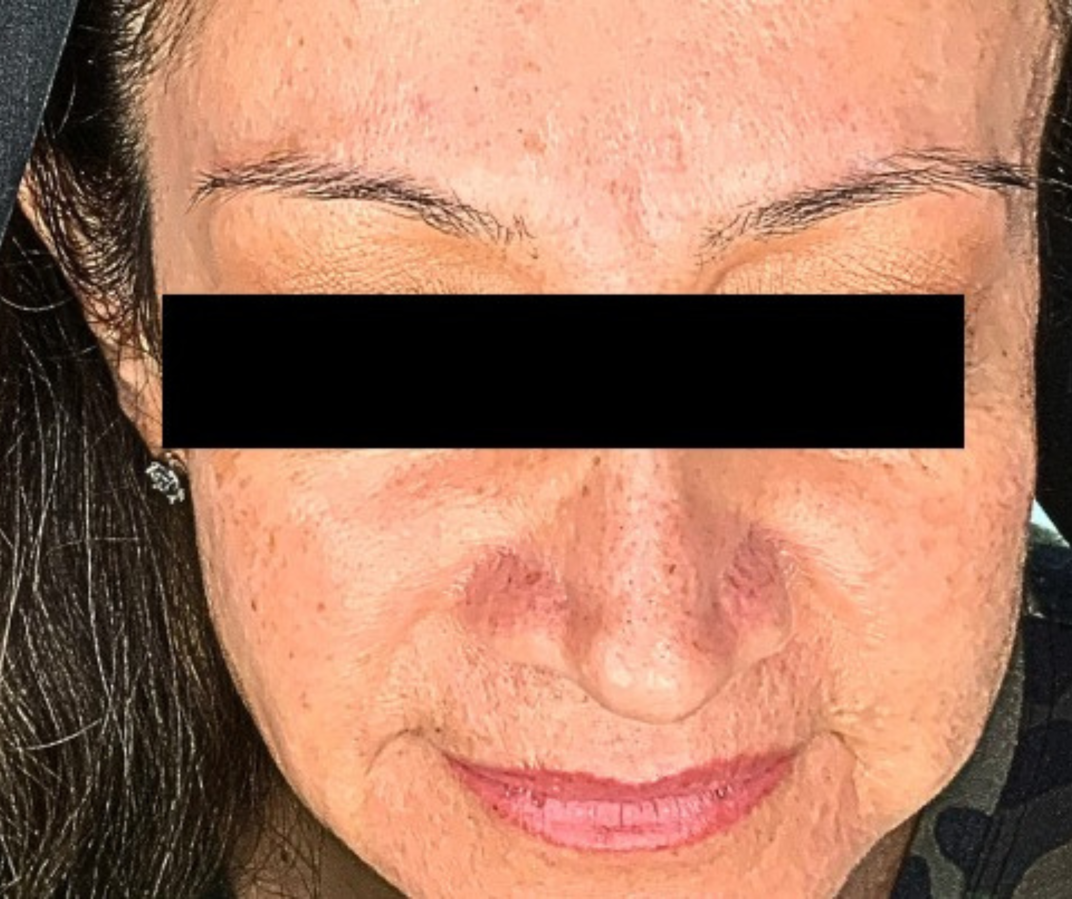Before DermSculpt BioNeedling Treatment in Melbourne clinic – Visible acne scars, uneven skin texture, and enlarged pores.