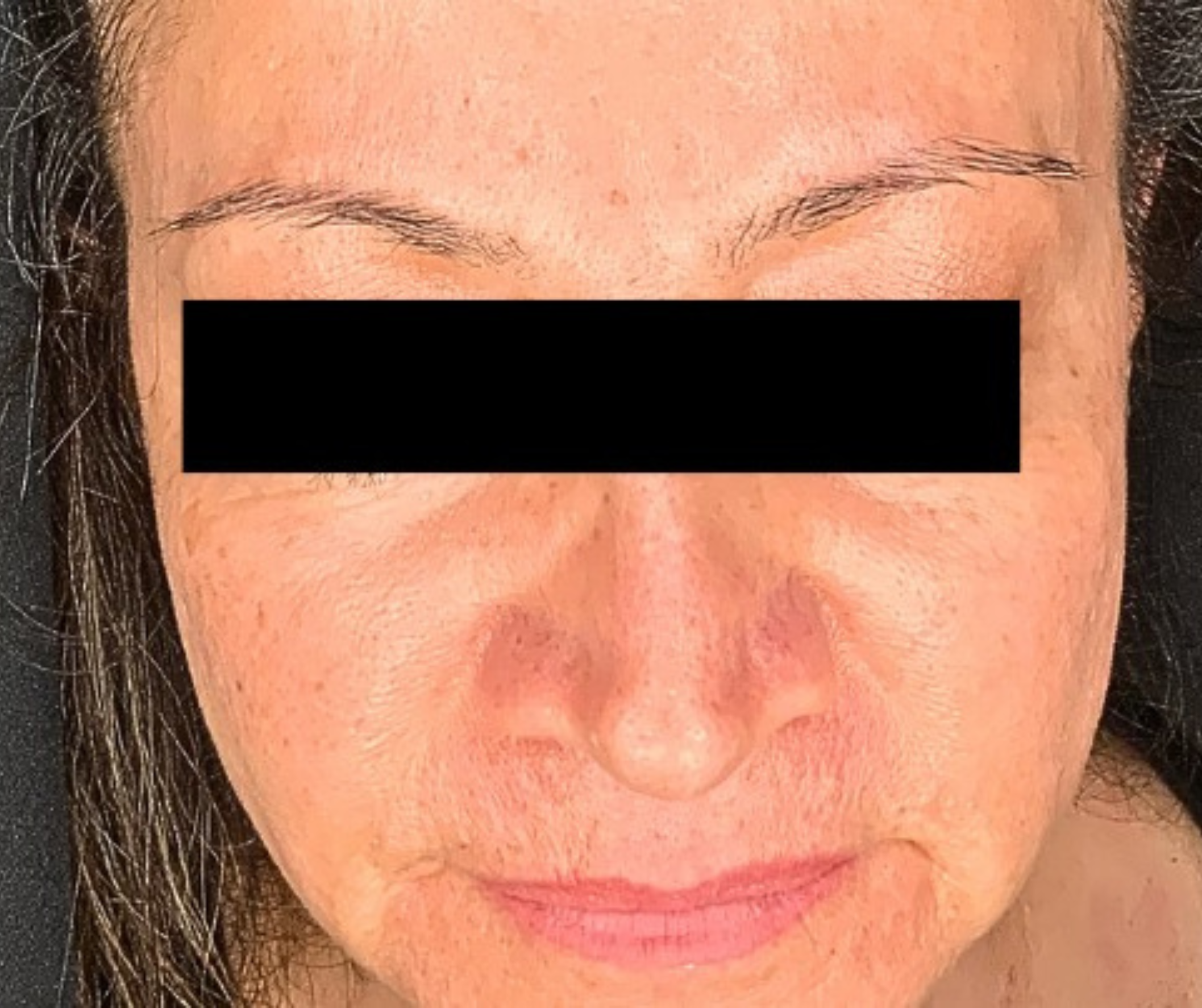 After DermSculpt BioNeedling Treatment in Melbourne clinic – Clearer skin, reduced acne scars, improved skin texture, and minimised pores.