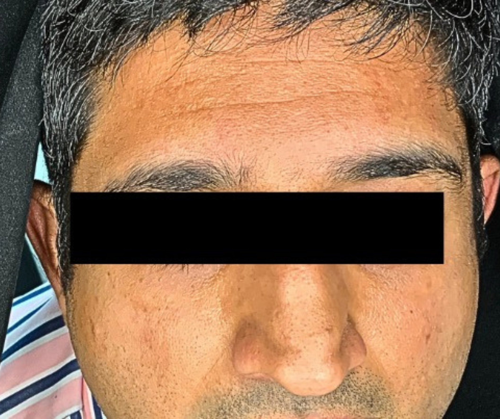 Before DermSculpt BioNeedling Treatment in Melbourne clinic – Visible acne scars, uneven skin texture, and enlarged pores.