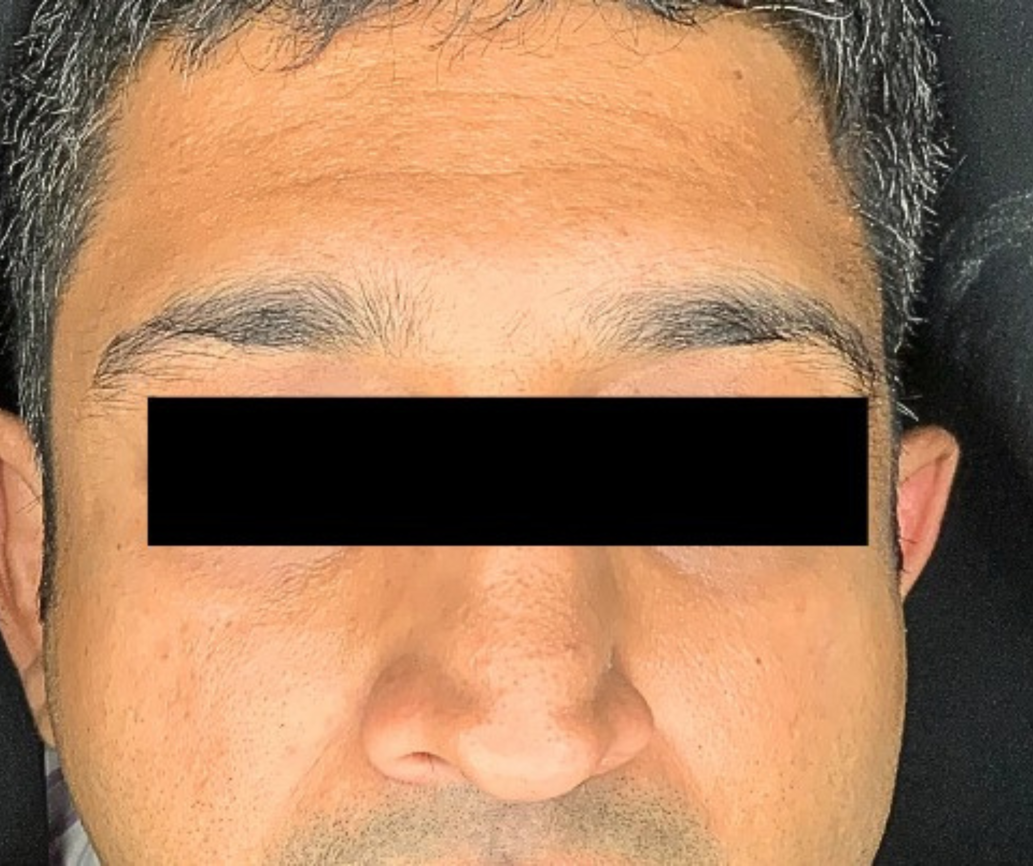 After DermSculpt BioNeedling Treatment in Melbourne clinic – Clearer skin, reduced acne scars, improved skin texture, and minimised pores.